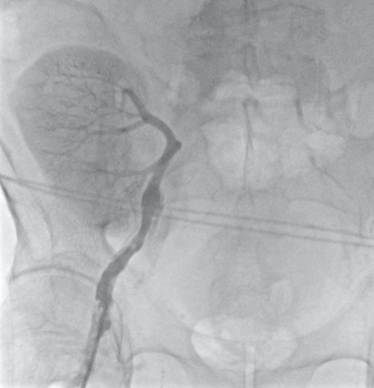Ретроградная ангиография бедренной артерии справа