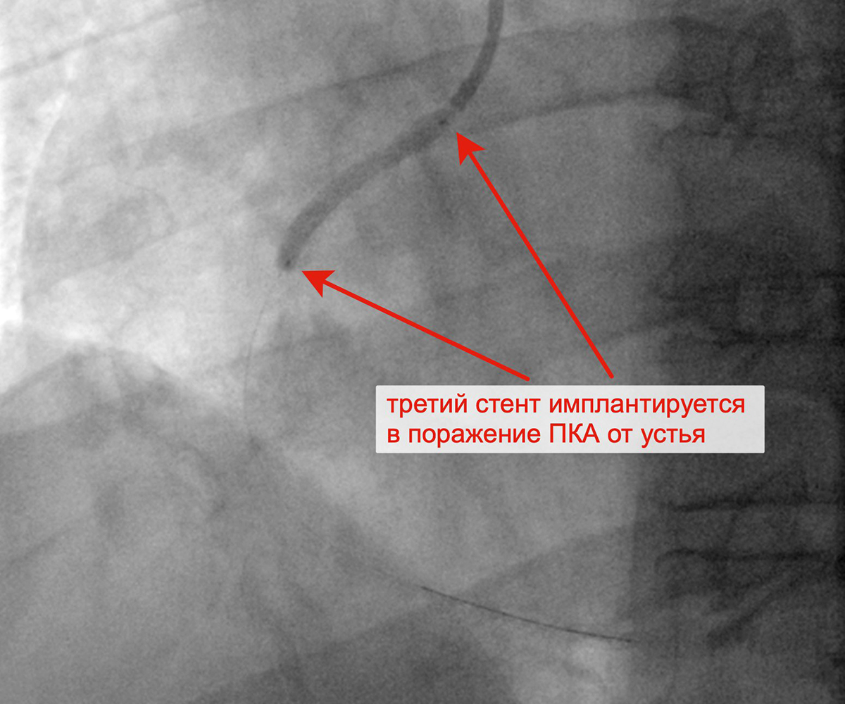 Имплантация третьего стента в ПКА от устья артерии