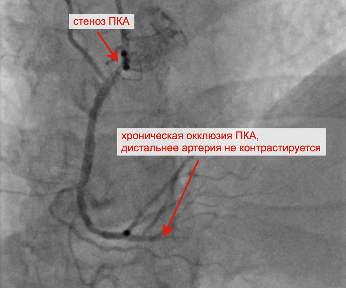 Хроническая окклюзия правой коронарной артерии