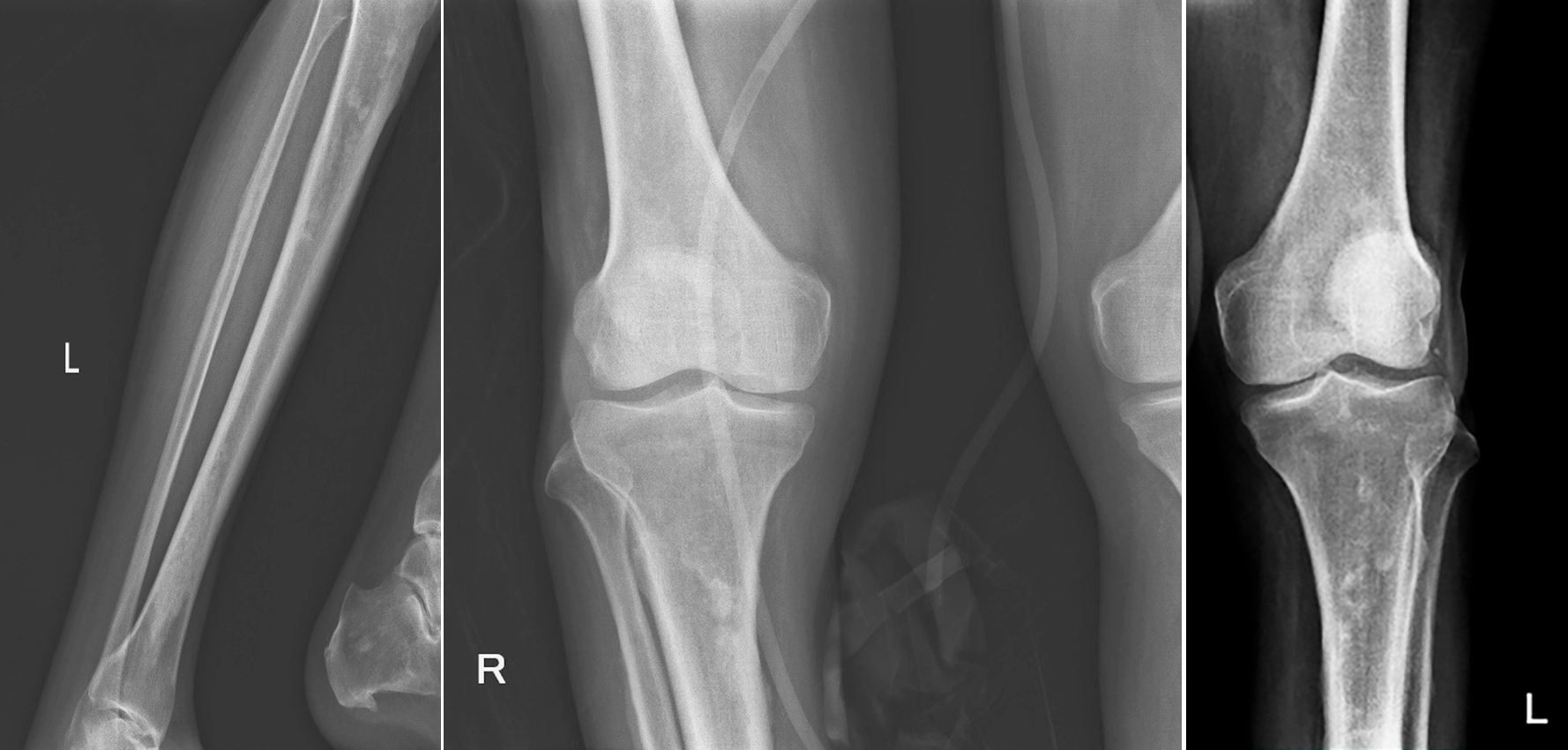 Поражение костей
