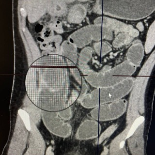 Компьютерная томография пациента