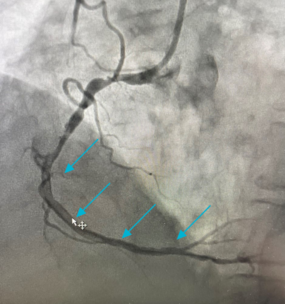 В просвете сосуда визуализируется протяженный тромб