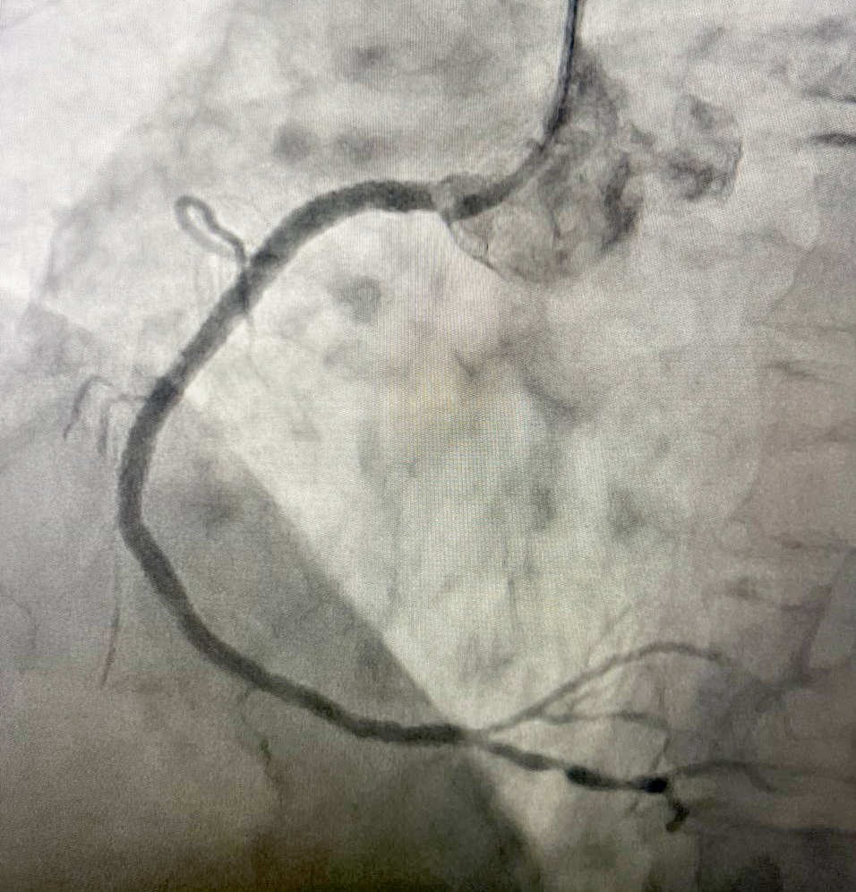 На контрольной ангиограмме коронарный кровоток в бассейне ПКА, раскрытие стента полное, позиционирование адекватное. 