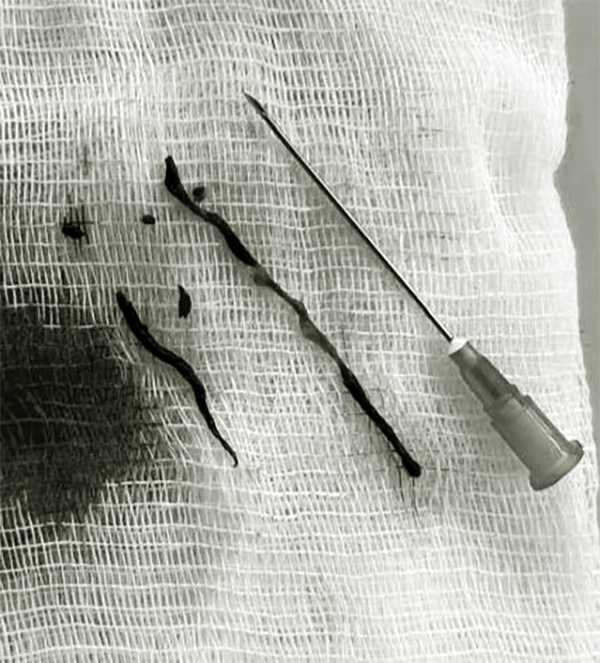 Аспирированный тромб