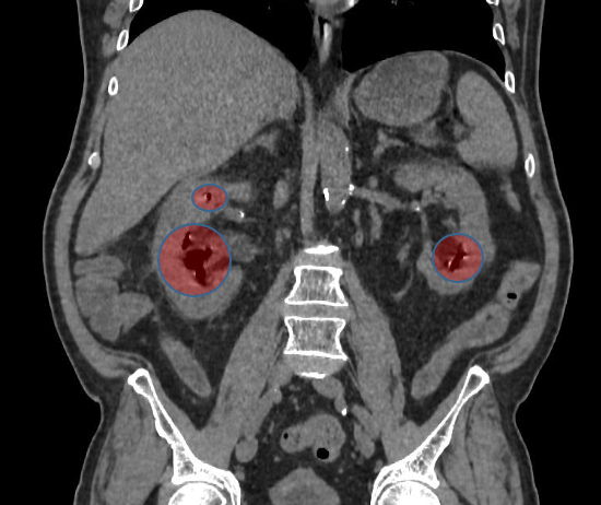 Компьютерная томография почек пациента