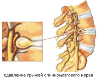 Остеохондроз плечевого отдела: симптомы и лечение